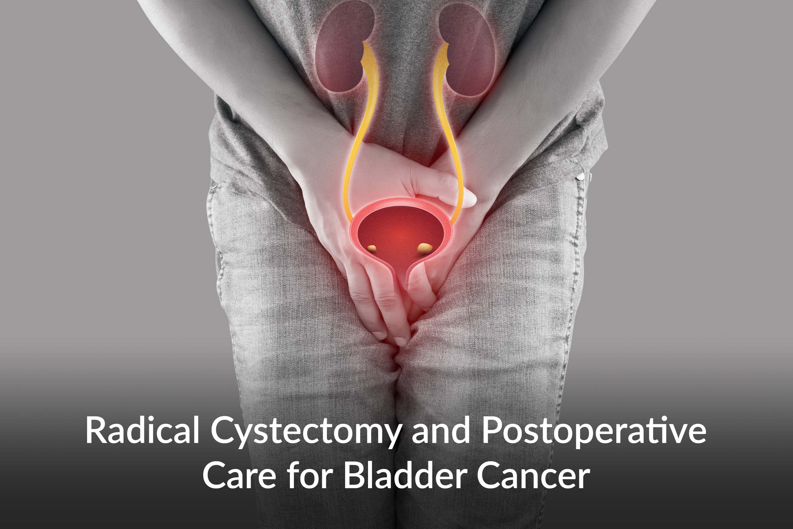 Radical Cystectomy and Postoperative Care for Bladder Cancer